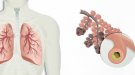 Diagnostiquen prop de 1.400 pacients de malaltia pulmonar obstructiva crònica l'any 2020 a Ponent i l'Alt Pirineu i Aran