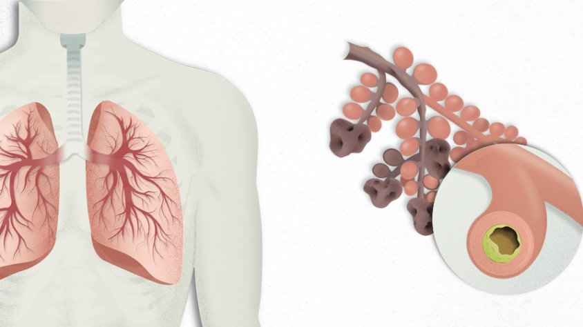 Diagnostiquen prop de 1.400 pacients de malaltia pulmonar obstructiva crònica l'any 2020 a Ponent i l'Alt Pirineu i Aran